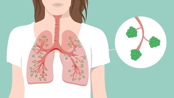 Bronchialsystem: Darstellung von Lunge, Bronchien und Bronchiolen.