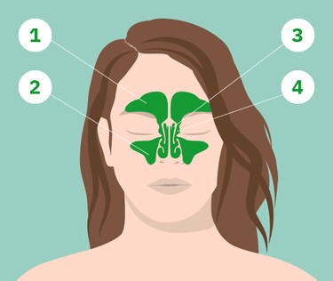 Akute Und Chronische Pansinusitis Was Ist Das Gelomyrtol Forte