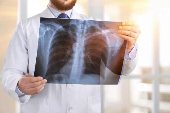 Röntgenbild der Lunge in den Händen eines Arztes – Symbol für Gesundheit und Atemwegsuntersuchung. Arzt in weißem Kittel hält ein Röntgenbild des Brustkorbs, auf dem die Lunge und Rippen sichtbar sind, vor einem hellen, lichtdurchfluteten Hintergrund.