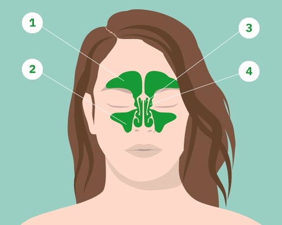 Grafik zur Lokalisierung der Nebenhöhlen, die sich im Rahmen einer Sinusitis entzünden können.